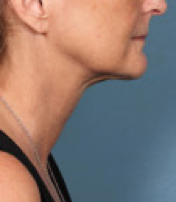 Kybella Treatment Youngstown