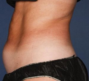 Before Liposonix